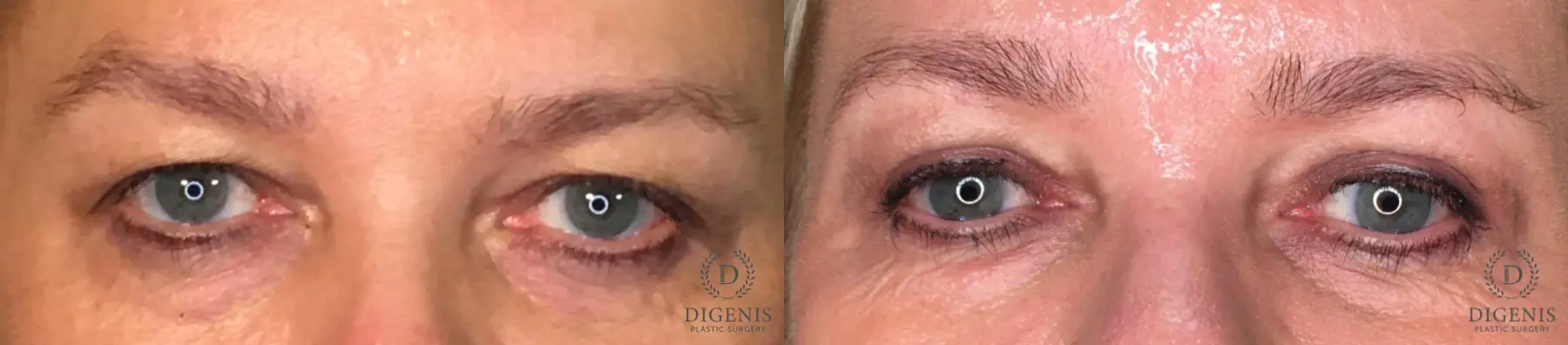 Eyelid Surgery: Patient 21 - Before and After  