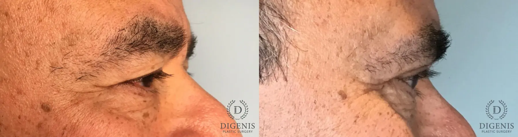 Eyelid Surgery: Patient 82 - Before and After 3