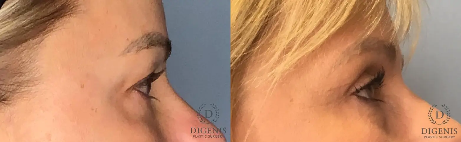 Eyelid Surgery: Patient 24 - Before and After 3