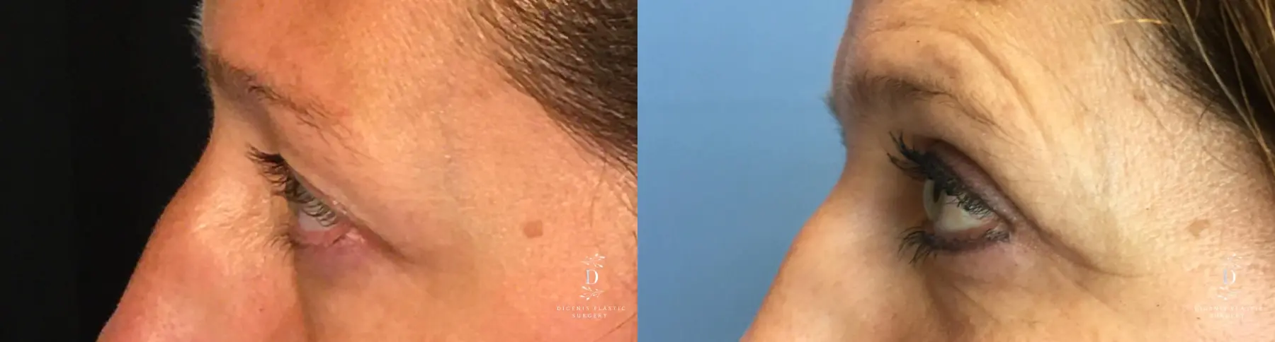 Eyelid Surgery: Patient 17 - Before and After 5