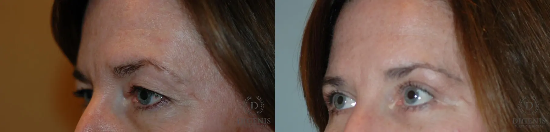 Eyelid Surgery: Patient 3 - Before and After 3
