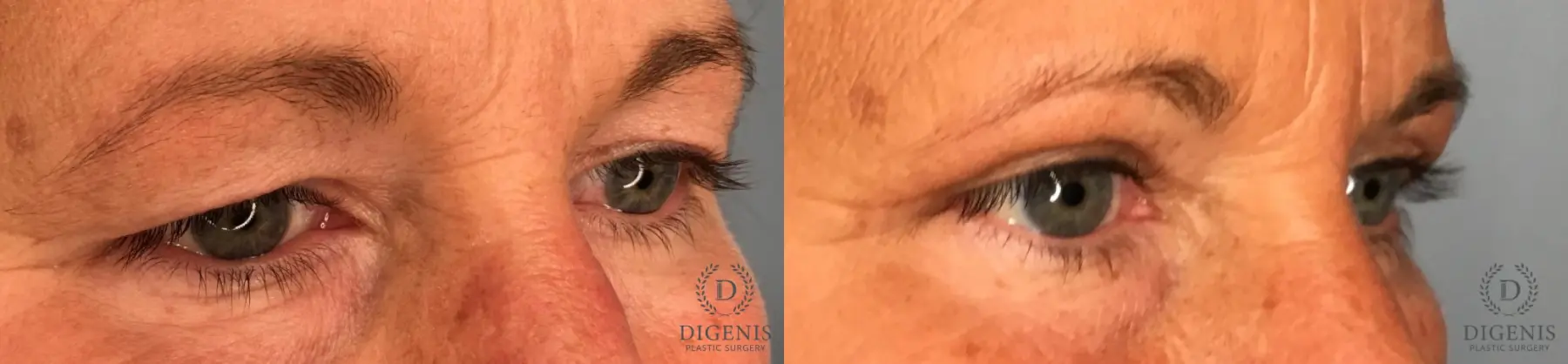 Eyelid Surgery: Patient 69 - Before and After 4