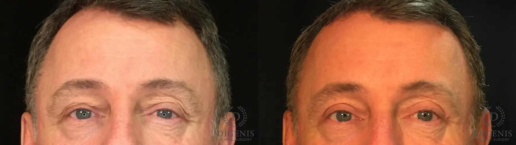 Eyelid Surgery: Patient 1 - Before and After  