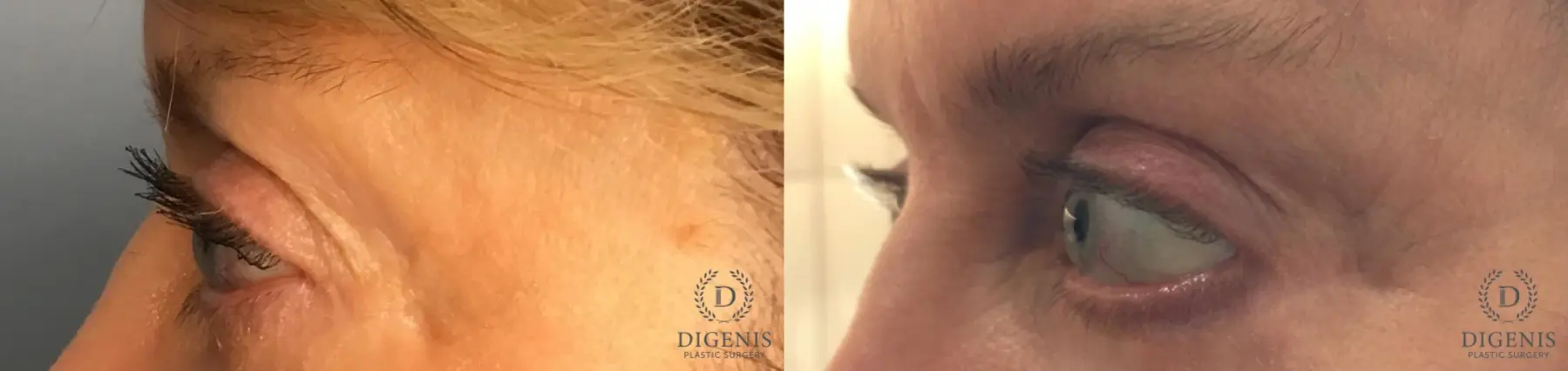Eyelid Surgery: Patient 70 - Before and After 3