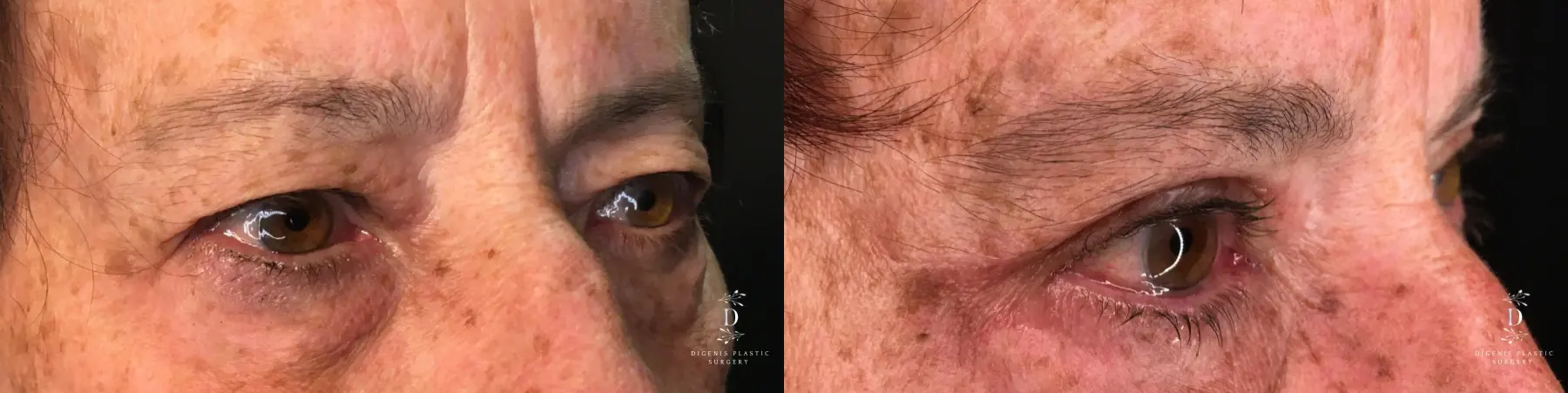 Eyelid Surgery: Patient 26 - Before and After 2