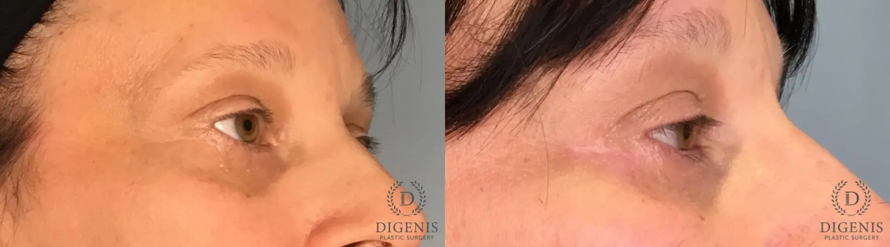 Eyelid Surgery: Patient 3 - Before and After 4