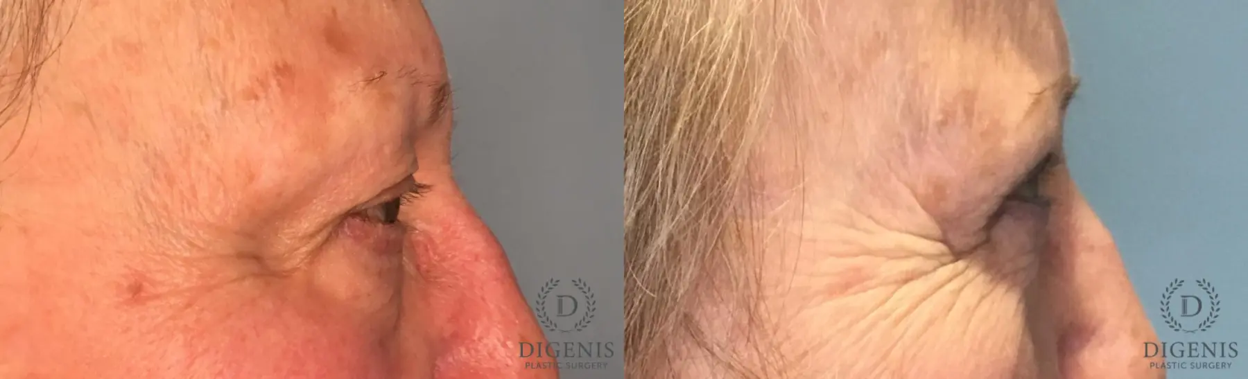 Eyelid Surgery: Patient 75 - Before and After 2