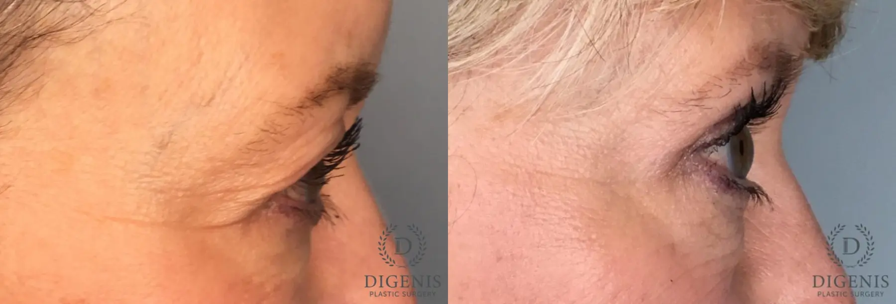 Eyelid Surgery: Patient 80 - Before and After 5