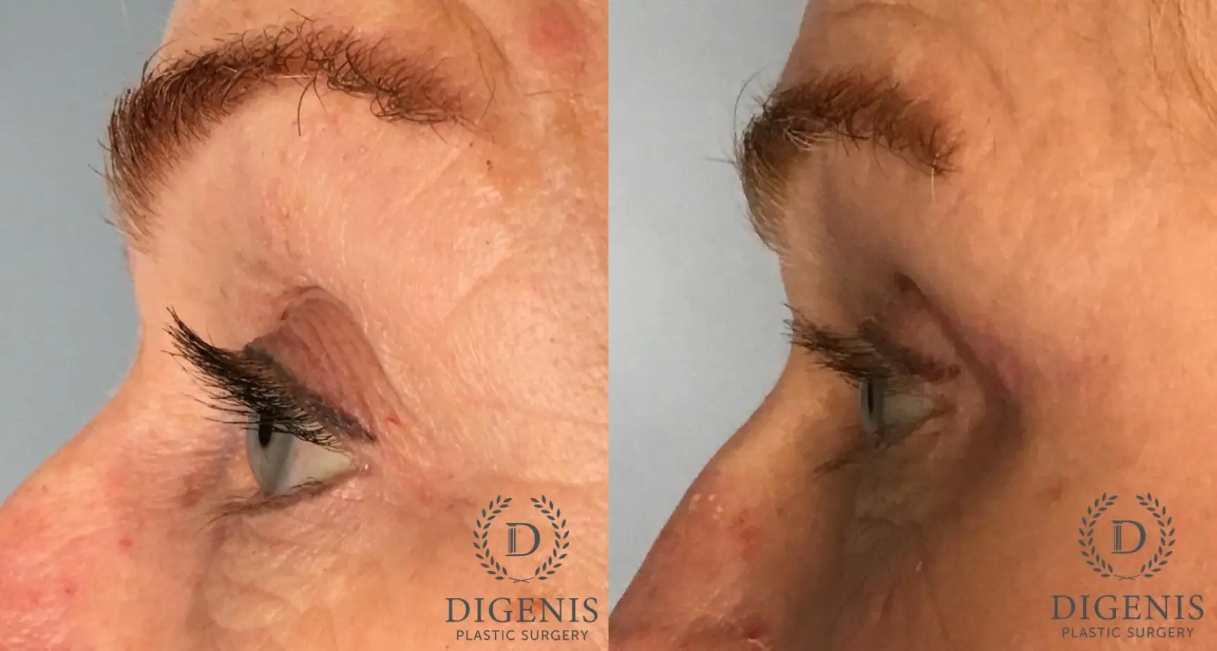 Eyelid Surgery: Patient 71 - Before and After 3