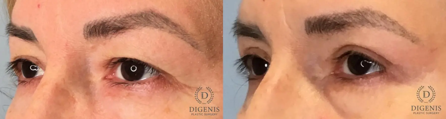 Eyelid Surgery: Patient 67 - Before and After 2