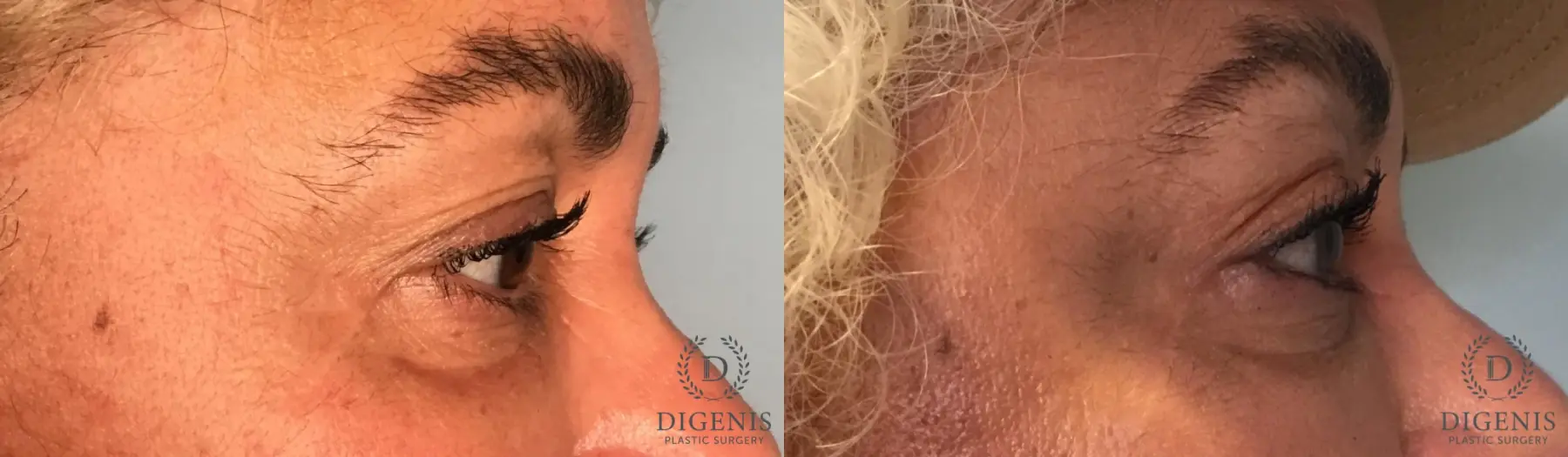 Eyelid Surgery: Patient 13 - Before and After 5