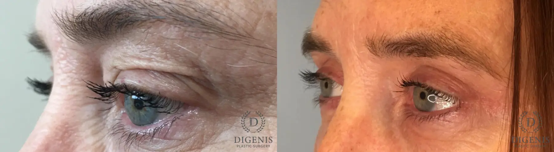 Eyelid Surgery: Patient 60 - Before and After 6