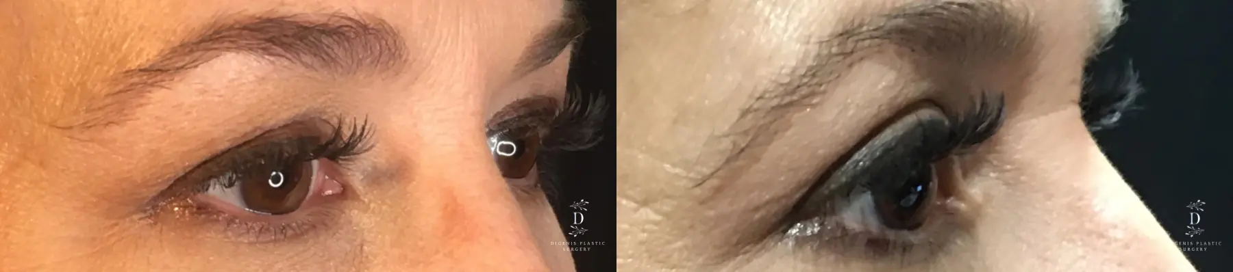 Eyelid Surgery: Patient 30 - Before and After 2