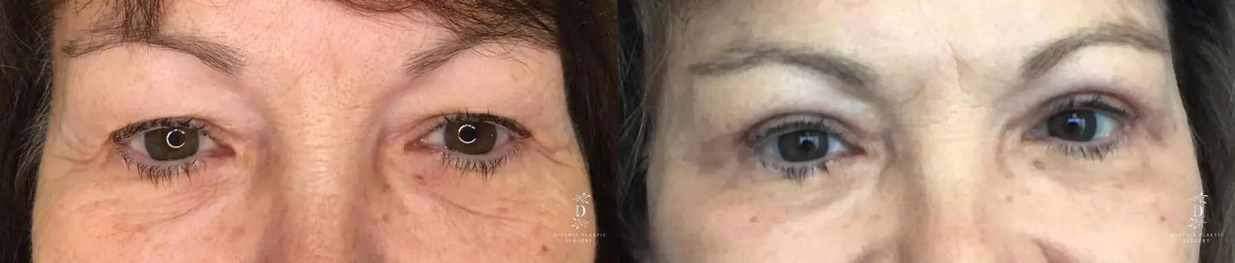 Eyelid Surgery: Patient 20 - Before and After 1