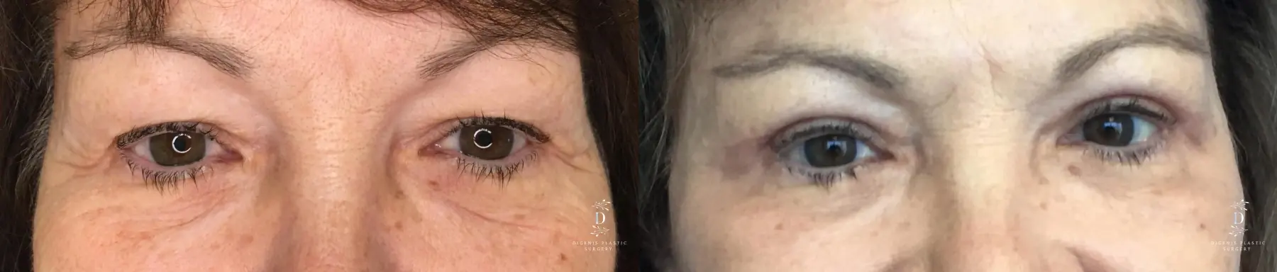 Eyelid Surgery: Patient 20 - Before and After  