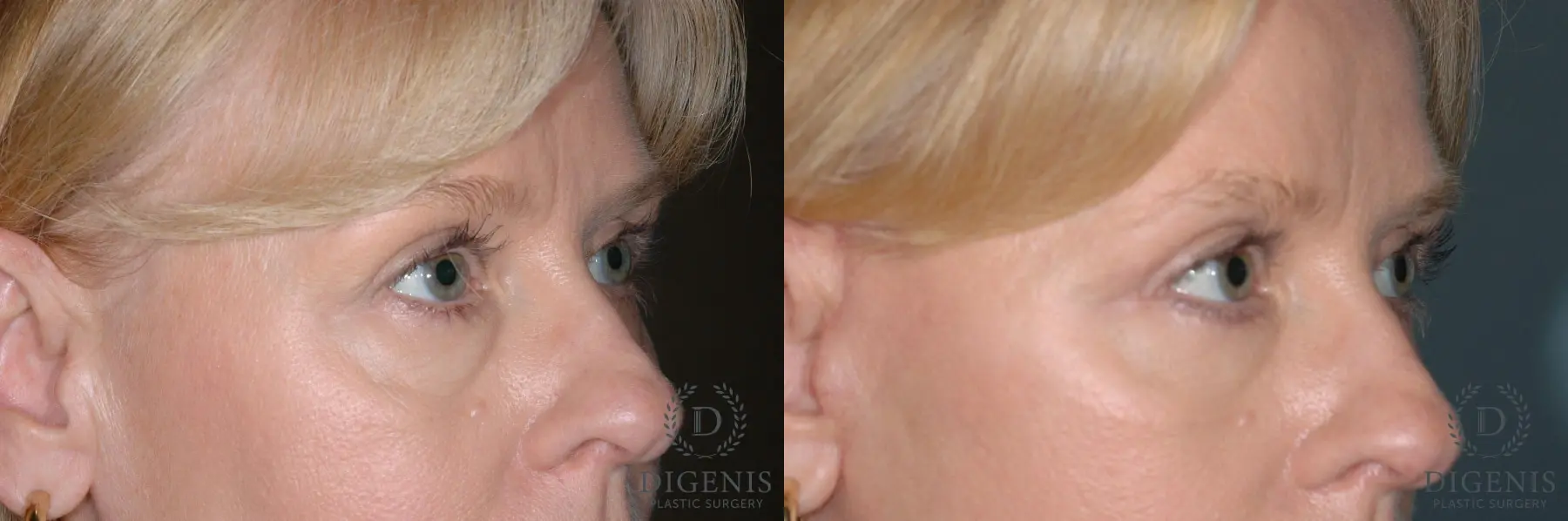 Eyelid Surgery: Patient 8 - Before and After 2