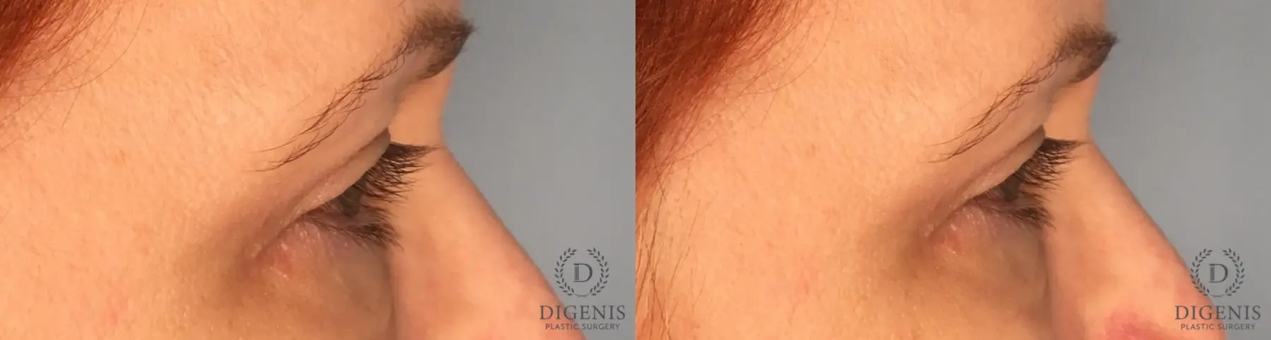 Eyelid Surgery: Patient 35 - Before and After 4