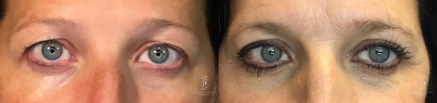 Eyelid Surgery: Patient 17 - Before and After  