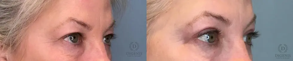 Eyelid Surgery: Patient 80 - Before and After 4