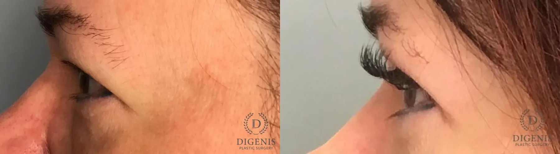 Eyelid Surgery: Patient 1 - Before and After 4