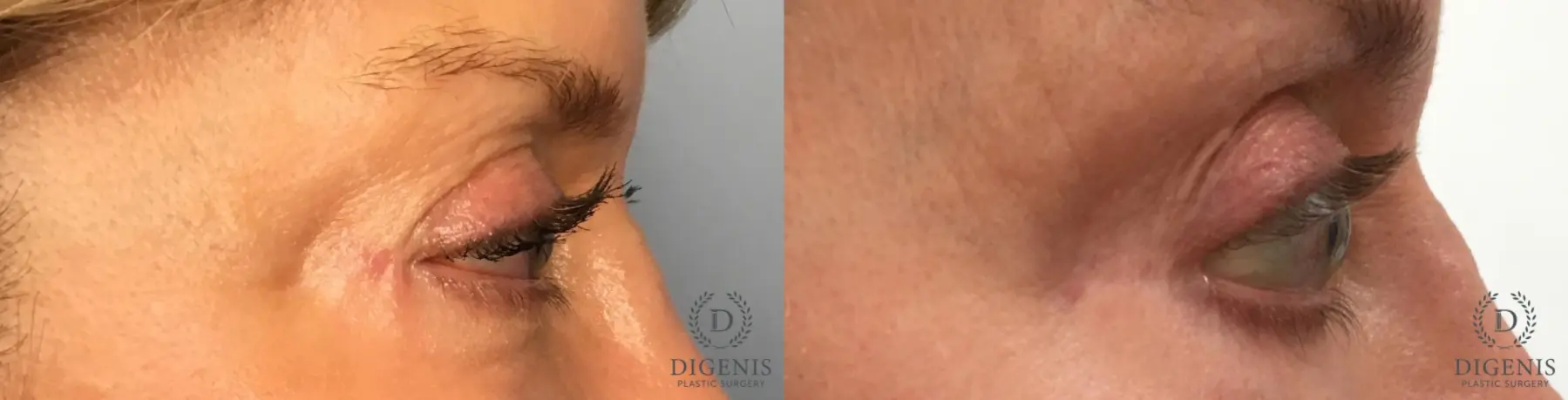 Eyelid Surgery: Patient 70 - Before and After 5
