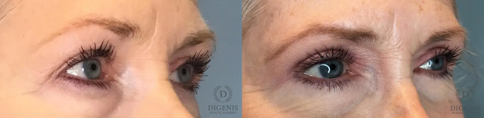 Eyelid Surgery: Patient 59 - Before and After 2