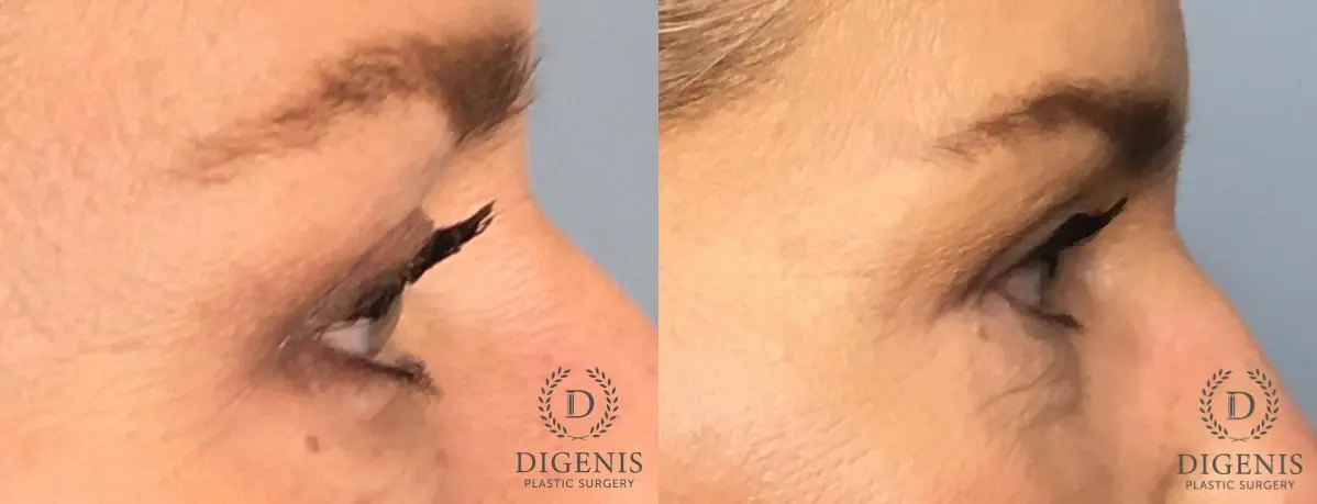 Eyelid Surgery: Patient 65 - Before and After 3