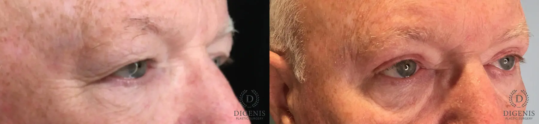 Eyelid Surgery: Patient 54 - Before and After 2