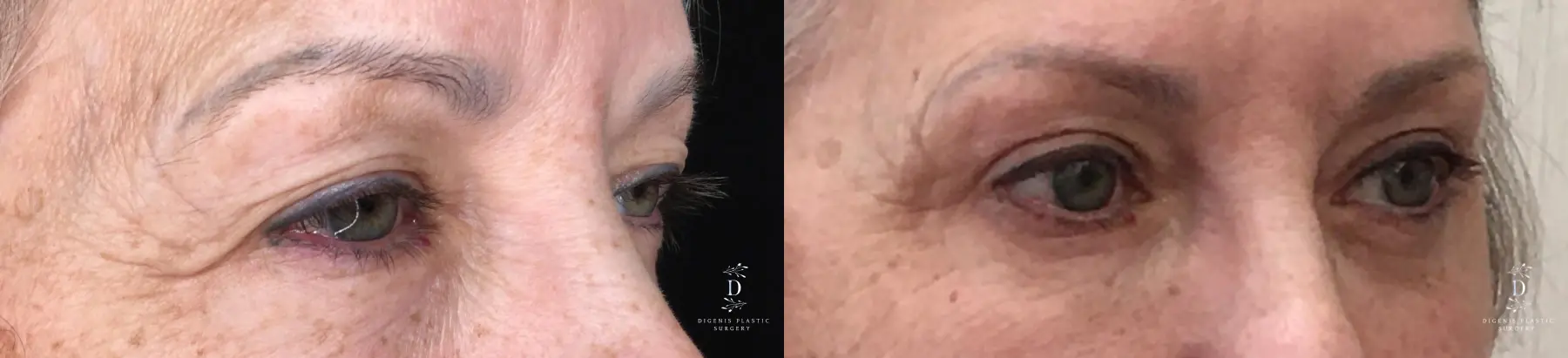 Eyelid Surgery: Patient 29 - Before and After 2