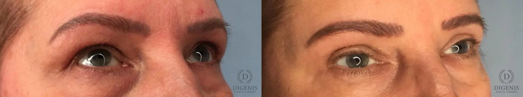 Eyelid Surgery: Patient 74 - Before and After 4