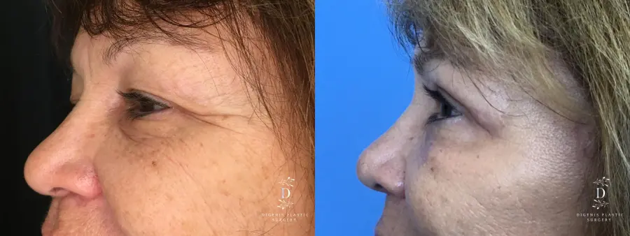 Eyelid Surgery: Patient 20 - Before and After 5