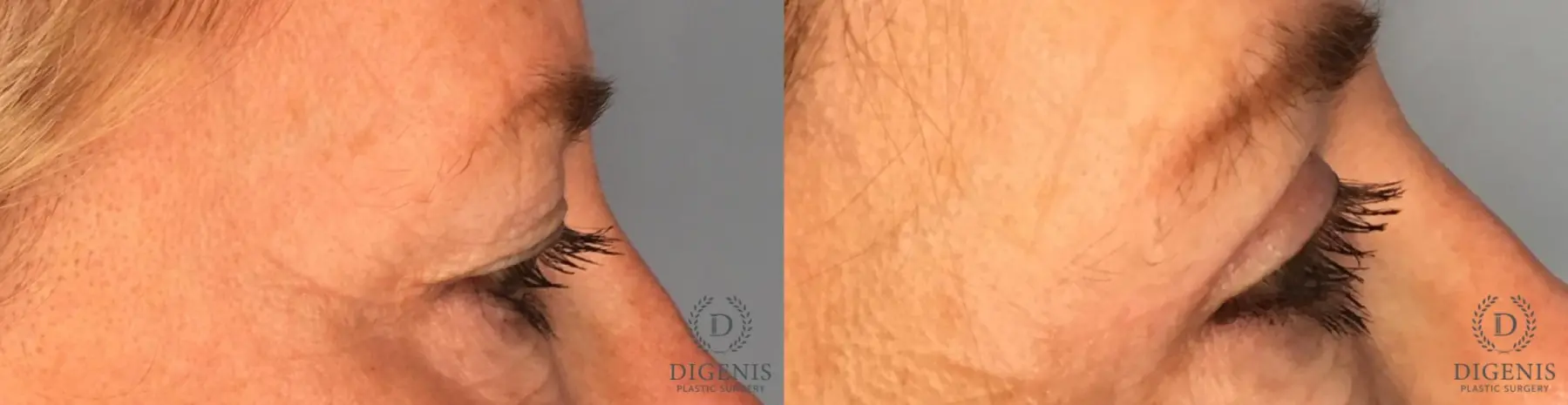 Eyelid Surgery: Patient 6 - Before and After 5