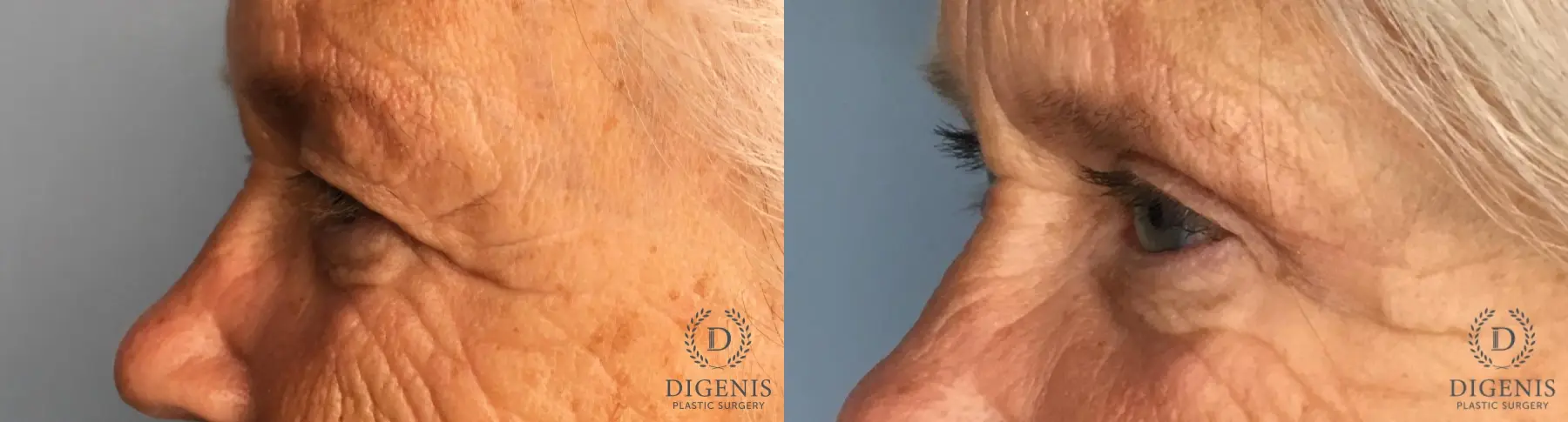 Eyelid Surgery: Patient 4 - Before and After 3