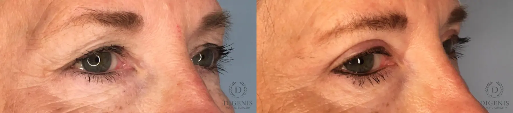 Eyelid Surgery: Patient 6 - Before and After 4