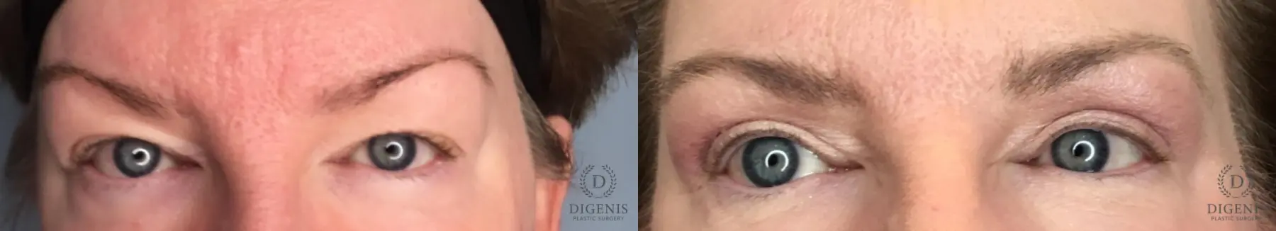 Eyelid Surgery: Patient 47 - Before and After 1