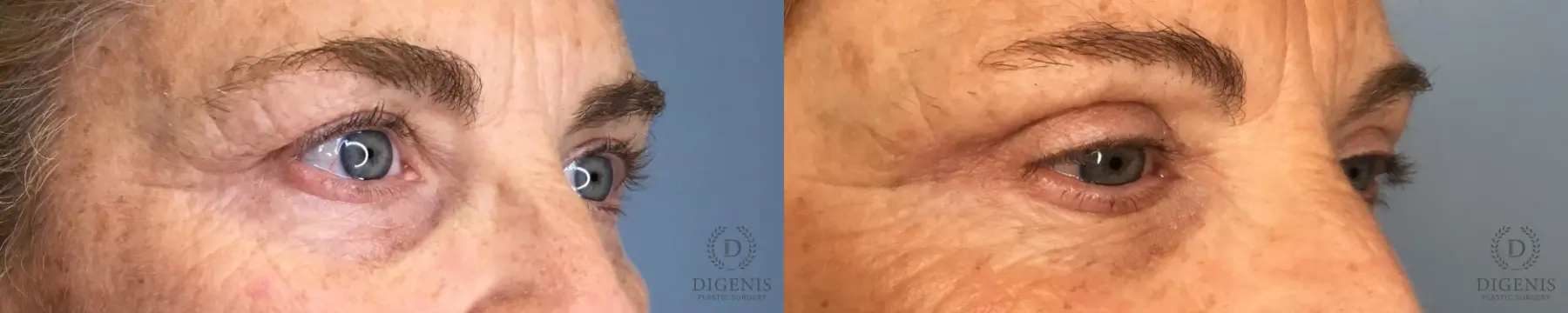Eyelid Surgery: Patient 10 - Before and After 4