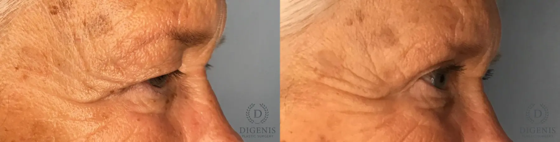 Eyelid Surgery: Patient 4 - Before and After 5