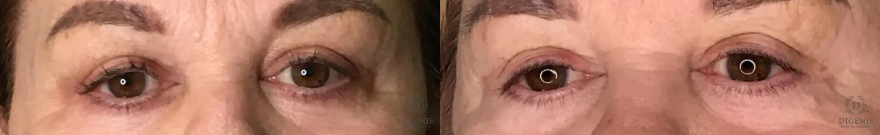 Eyelid Surgery: Patient 11 - Before and After  
