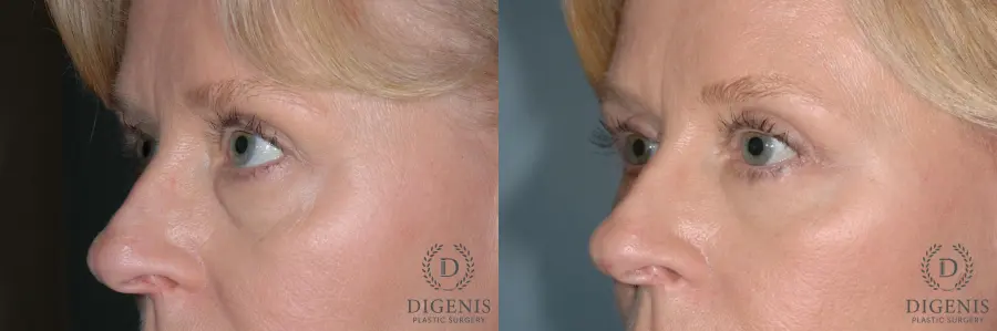 Eyelid Surgery: Patient 8 - Before and After 3
