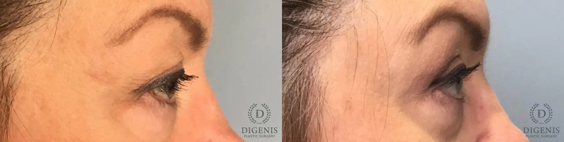 Eyelid Surgery: Patient 9 - Before and After 5