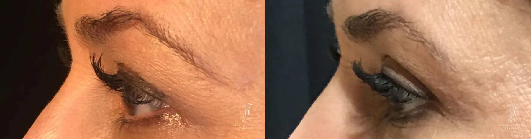 Eyelid Surgery: Patient 30 - Before and After 5
