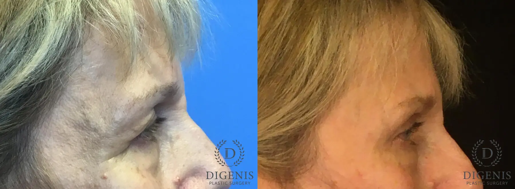 Eyelid Surgery: Patient 5 - Before and After 3
