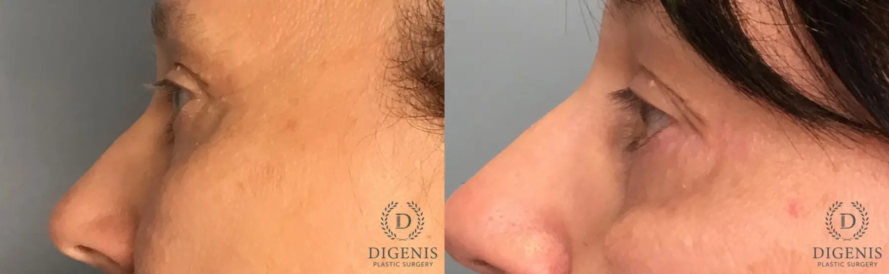 Eyelid Surgery: Patient 3 - Before and After 3