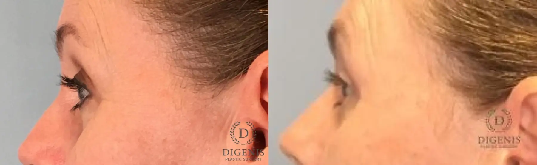 Eyelid Surgery: Patient 12 - Before and After 5