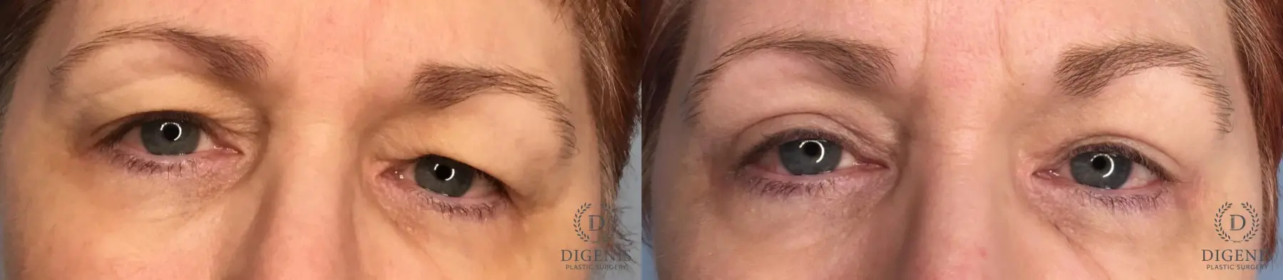 Eyelid Surgery: Patient 35 - Before and After 1
