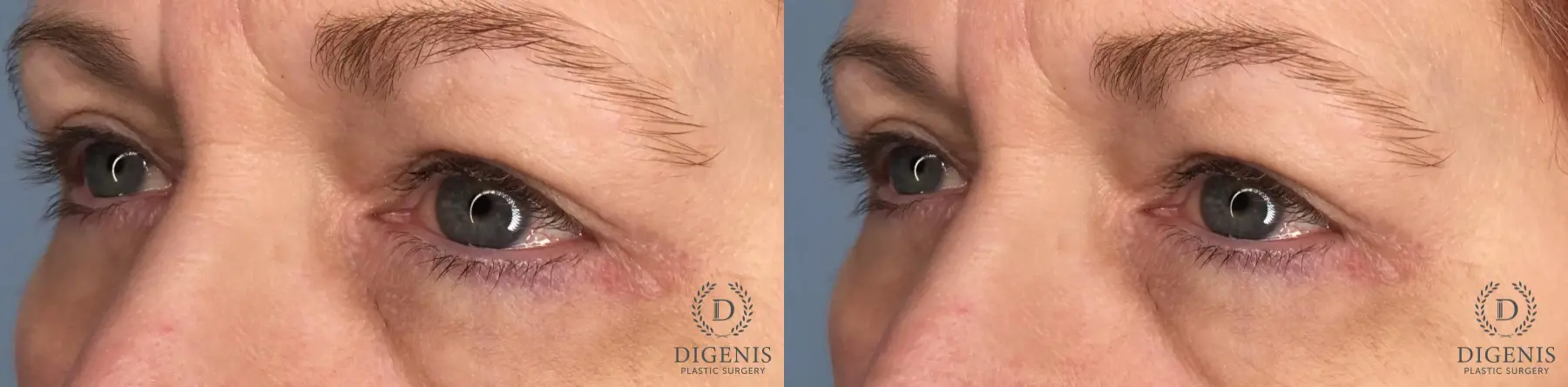 Eyelid Surgery: Patient 35 - Before and After 5