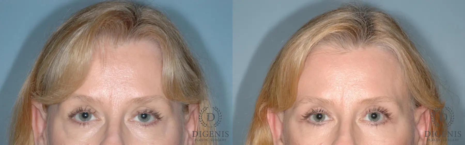 Eyelid Surgery: Patient 8 - Before and After 1