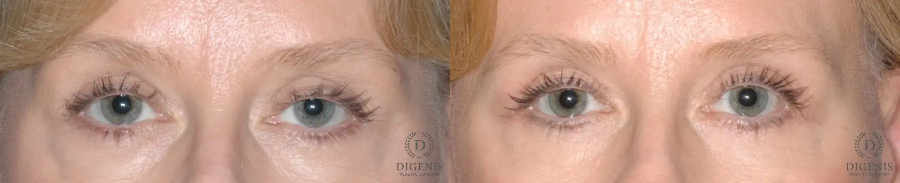 Eyelid Surgery: Patient 8 - Before and After  