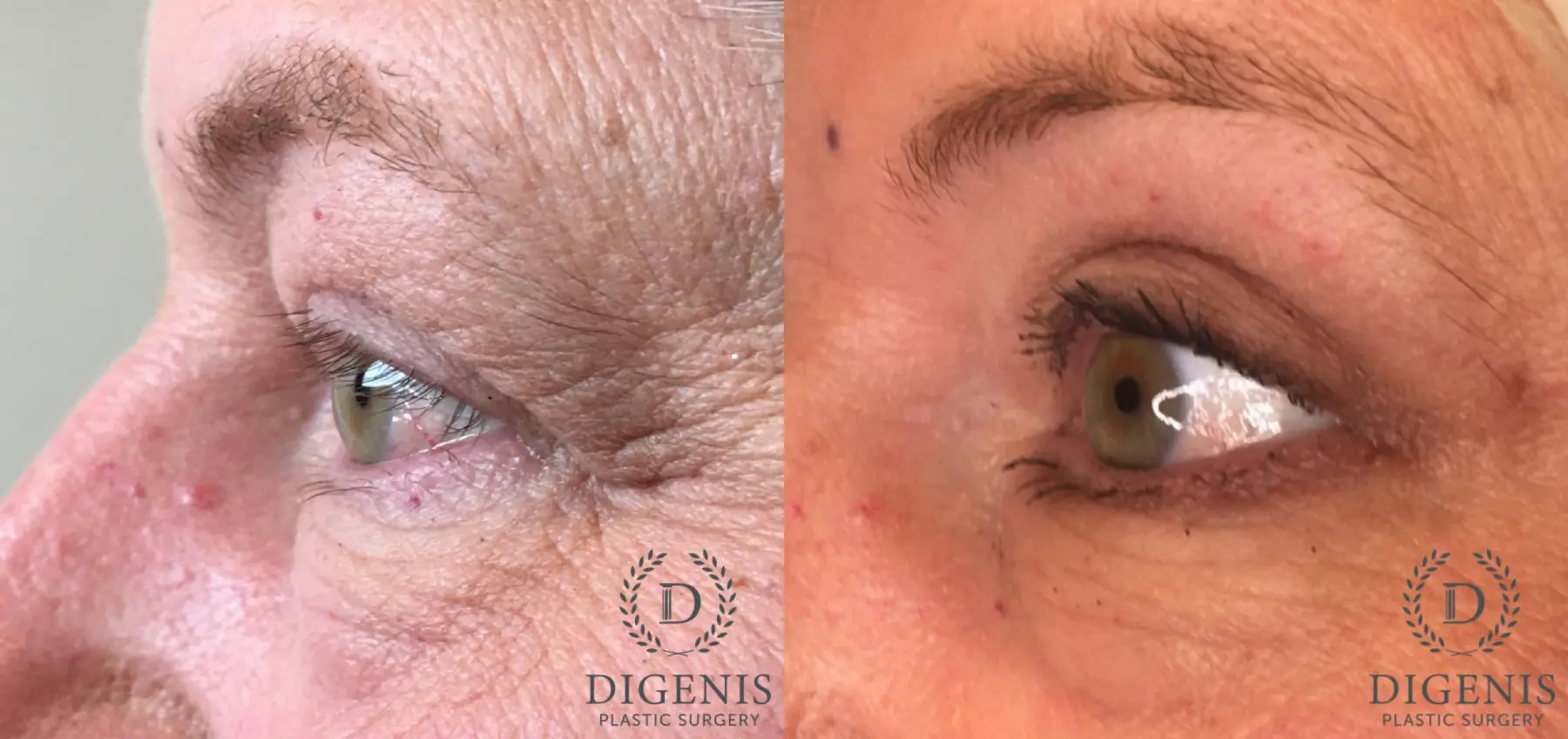 Eyelid Surgery: Patient 62 - Before and After 6