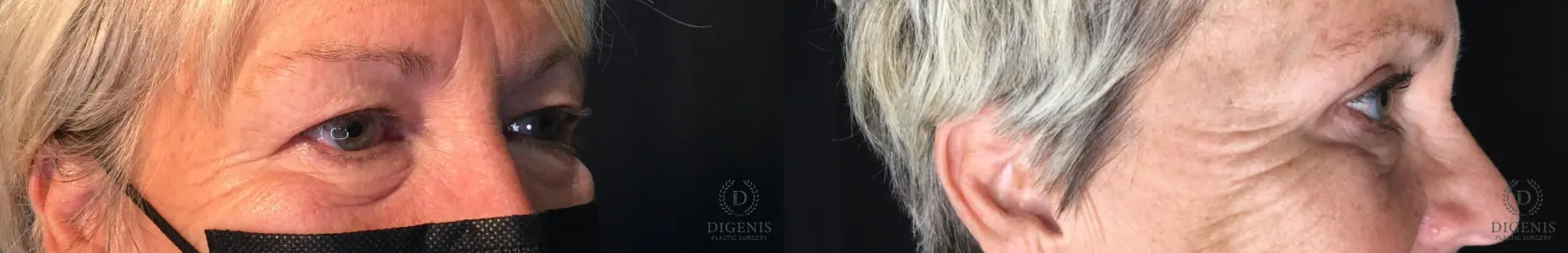 Eyelid Surgery: Patient 55 - Before and After 2